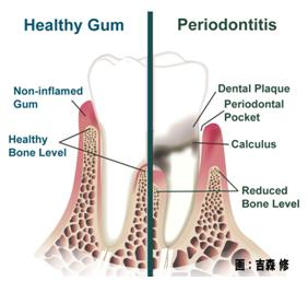 歯周病（periodontitis）の局所像