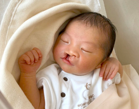 What are cleft lip and cleft palate?