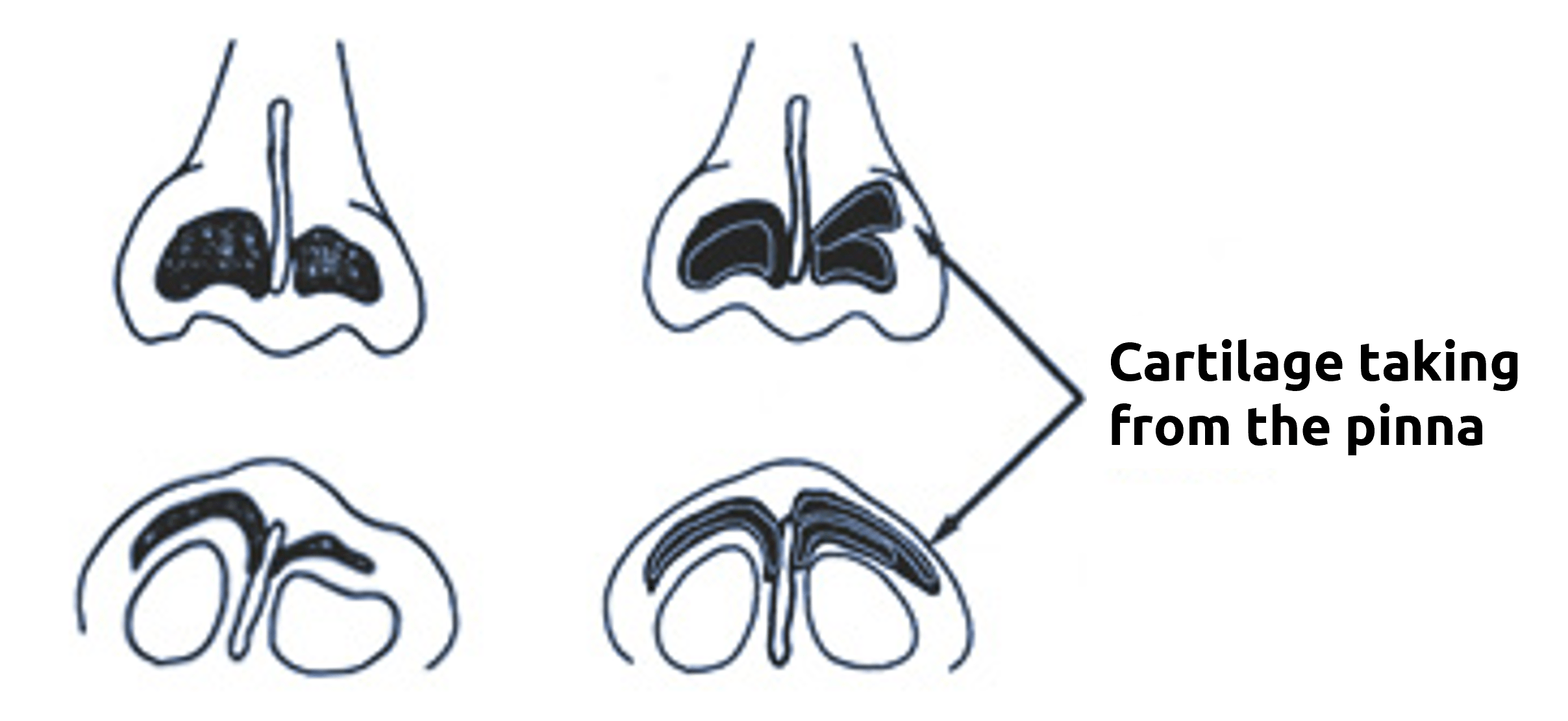 Figure: Cartilage collected from the auricle