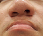 orrection of the external nose (external nose correction)