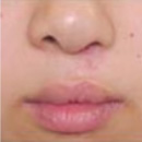 Secondary cleft lip repair
