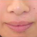 Secondary cleft lip repair