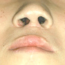 Abbe’s flap in secondary cleft lip repair