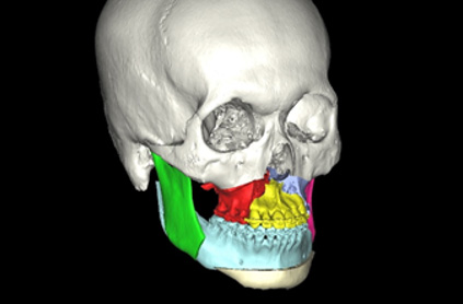 Segmental maxillary osteotomy + SSRO + genioplasty