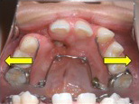 Expansion of upper dental arch