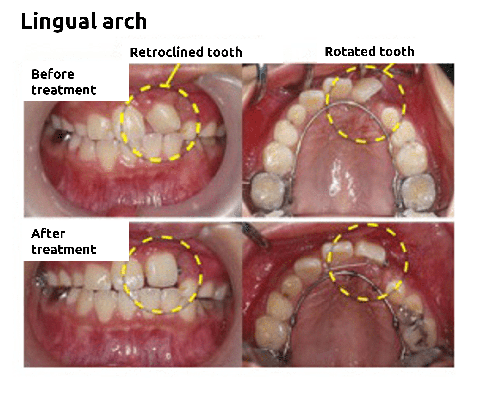 Lingual arch