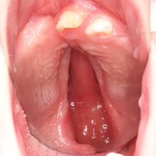 口蓋裂手術前