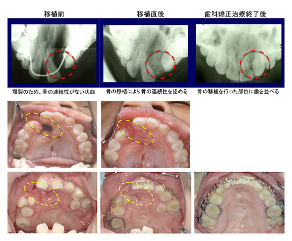 治療 | 大阪大学歯学部附属病院 口唇裂・口蓋裂・口腔顔面成育治療センター