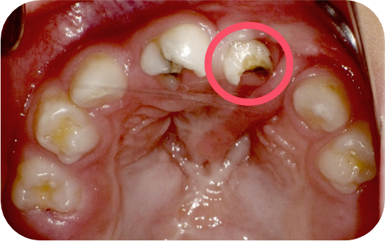 裂部に接する上の前歯のむし歯の一例