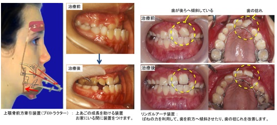 口蓋裂と言語治療 / 矯正治療 | 大阪大学大学院 歯学研究科 口腔外科学 